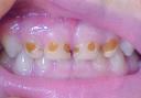 Anti-fluoride campaign now needs to focus on stopping child tooth decay
