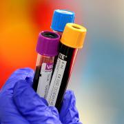 Scientists in Southampton are close to producing a blood test that could identify contagious patients with TB
