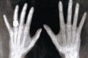 Artificial bones developed in Hampshire to heal broken limbs