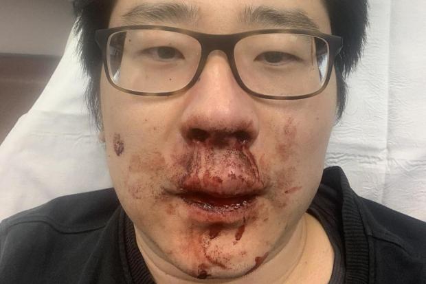 Daily Echo: Dr Peng Wang after the attack.