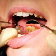 Fluoride in water 'improves children's dental health'
